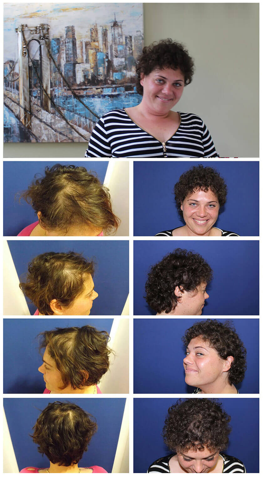 Obnova vlasov pre ženy