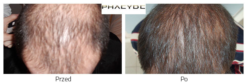 Przeszczep włosów Laslie D. 8000+ włosy